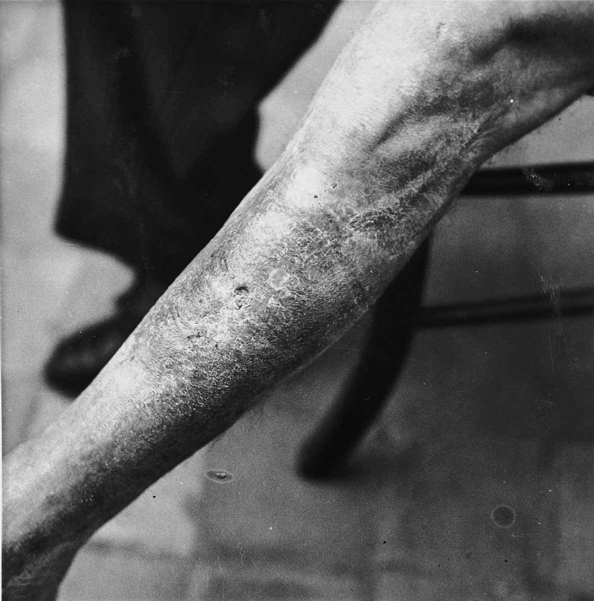 Emile Scieur shows the scarring on his leg that resulted from being beaten with a rubber truncheon in the Breendonk internment camp