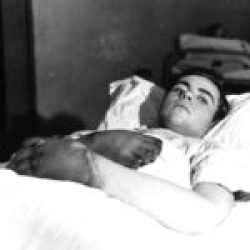 Battle of the Bulge Results of Frostbite for this US Soldier